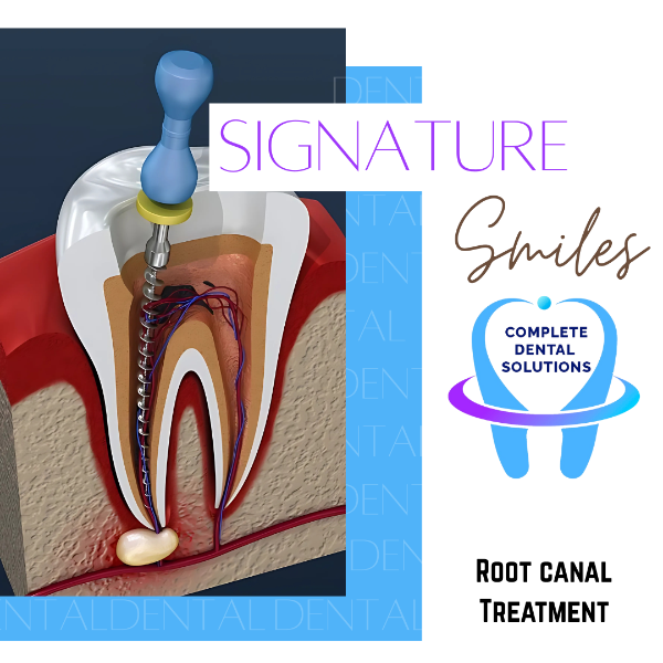 Root canal Treatment