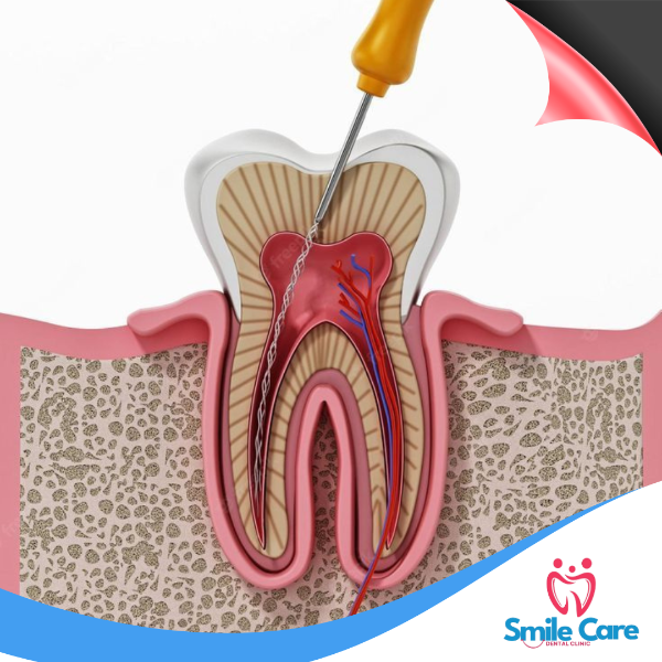 ROOT CANAL TREATMENT