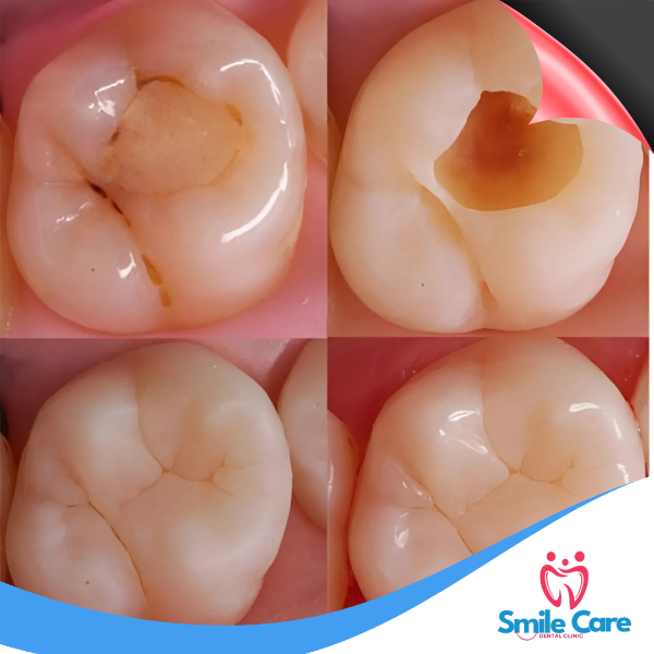 TOOTH COLOURED FILLINGS