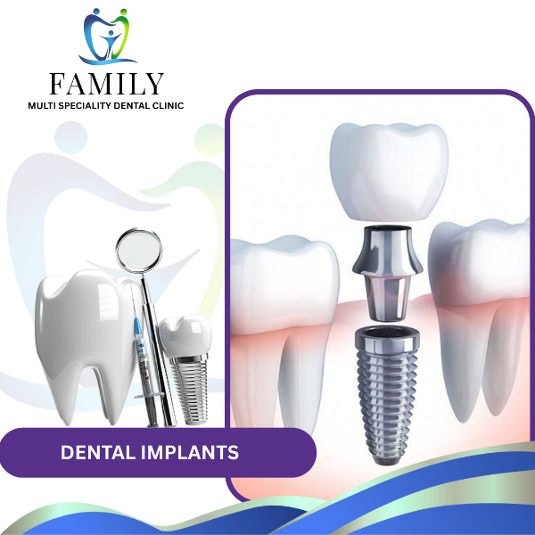 DENTAL IMPLANTS