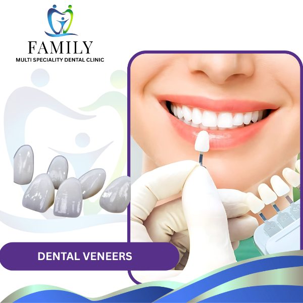 DENTAL VENEERS