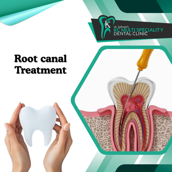 Root canal Treatment