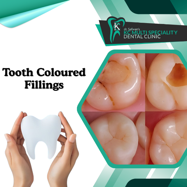 Tooth Coloured Fillings