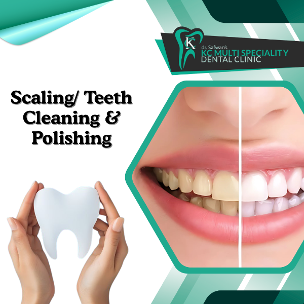 Scaling Teeth Cleaning & Polishing
