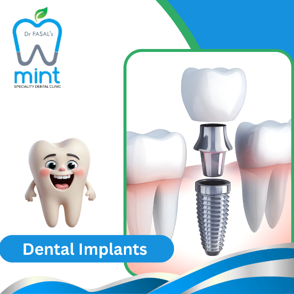 DENTAL IMPLANTS