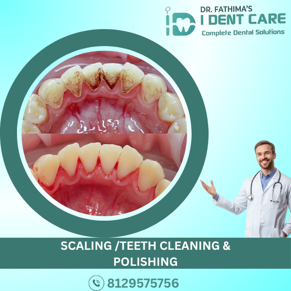 SCALING/TEETH CLEANING & POLISHING
