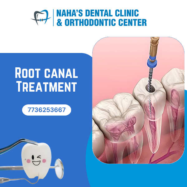 ROOT CANAL TREATMENT