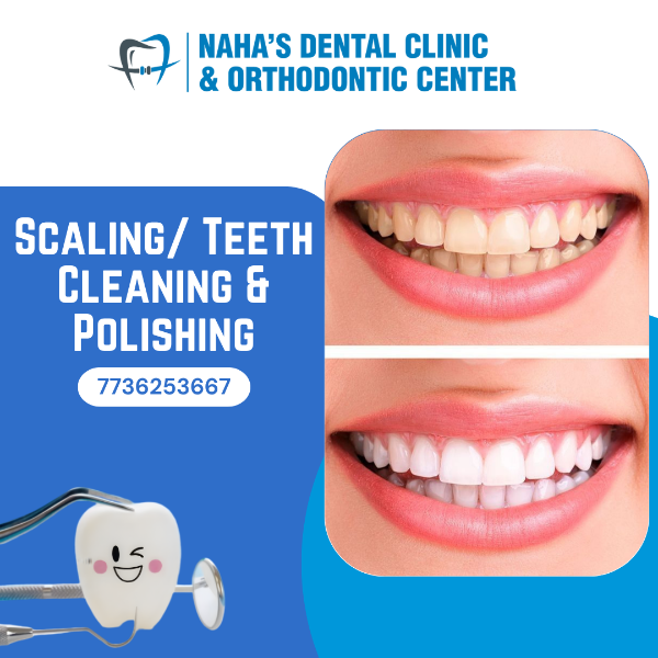 Scaling/ Teeth Cleaning & Polishing
