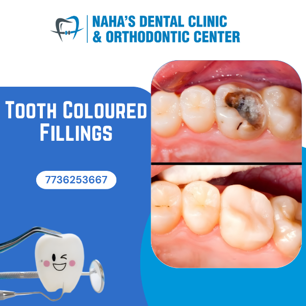 TOOTH COLOURED FILLINGS
