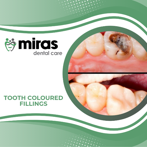 Tooth Coloured Fillings