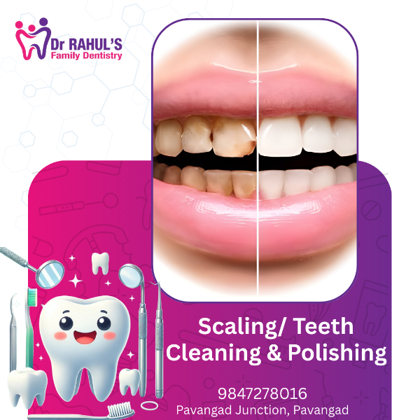 Scaling/ Teeth Cleaning & Polishing