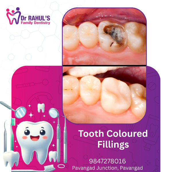 Tooth Coloured Fillings