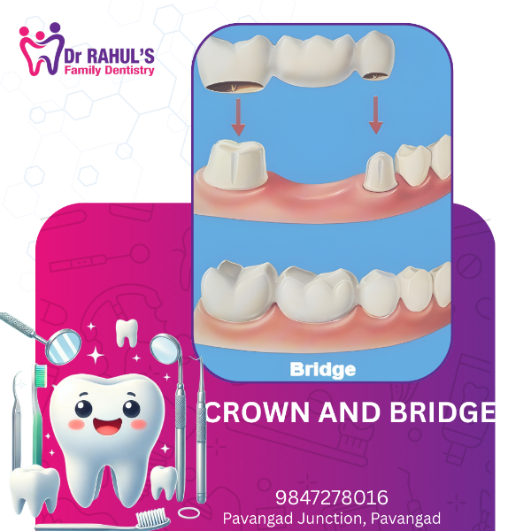 Crown and Bridge
