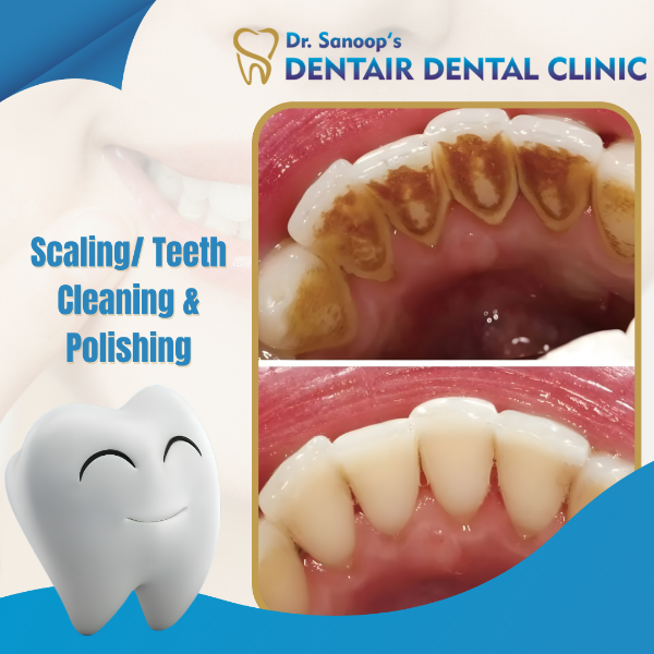 Scaling/ Teeth Cleaning & Polishing