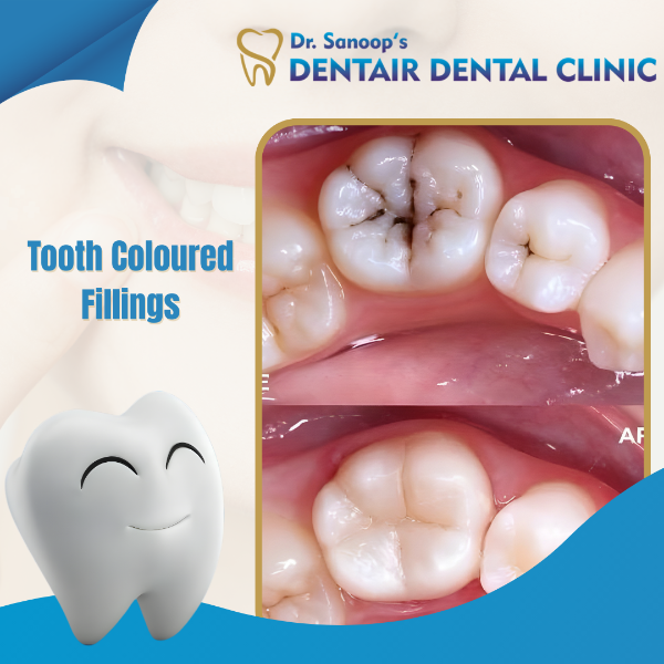 TOOTH COLOURED FILLINGS