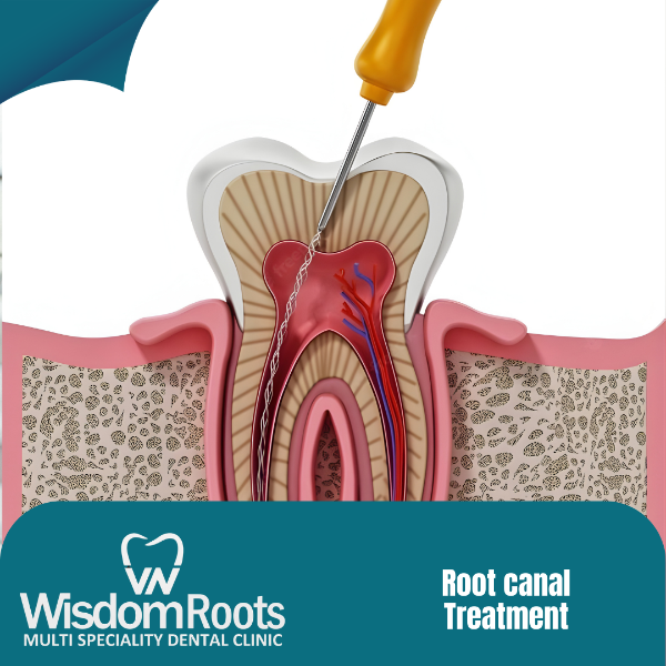 ROOT CANAL TREATMENT
