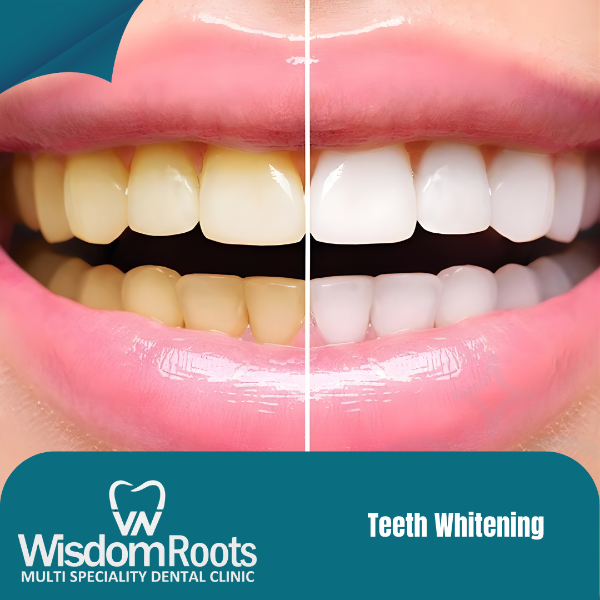 Teeth Whitening