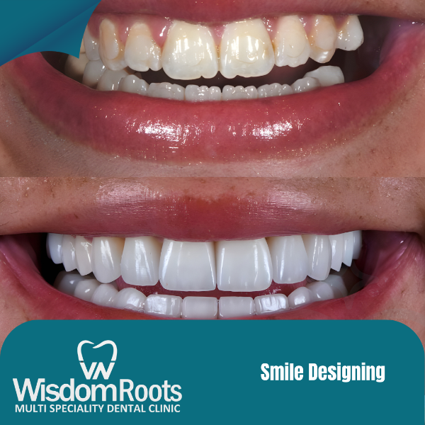 Smile Designing