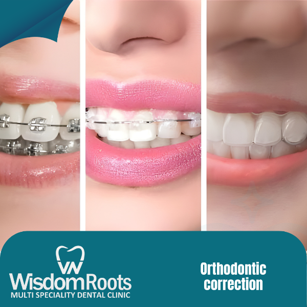 Orthodontic correction