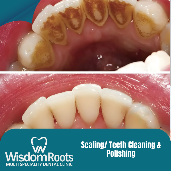 Scaling/ Teeth Cleaning & Polishing