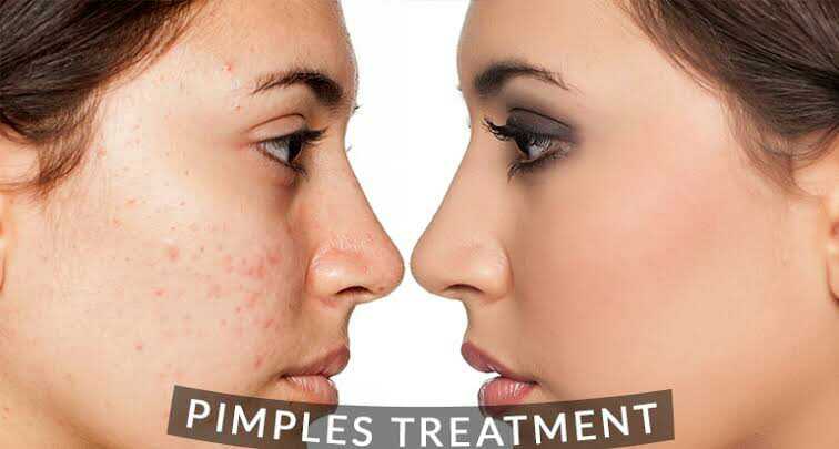 Pimple Treatment