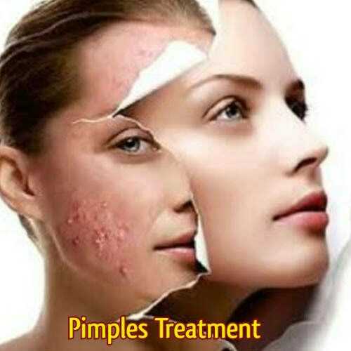 Pimple Treatment