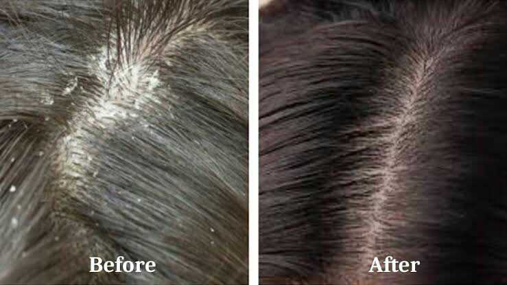 DANDRUFF TREATMENT